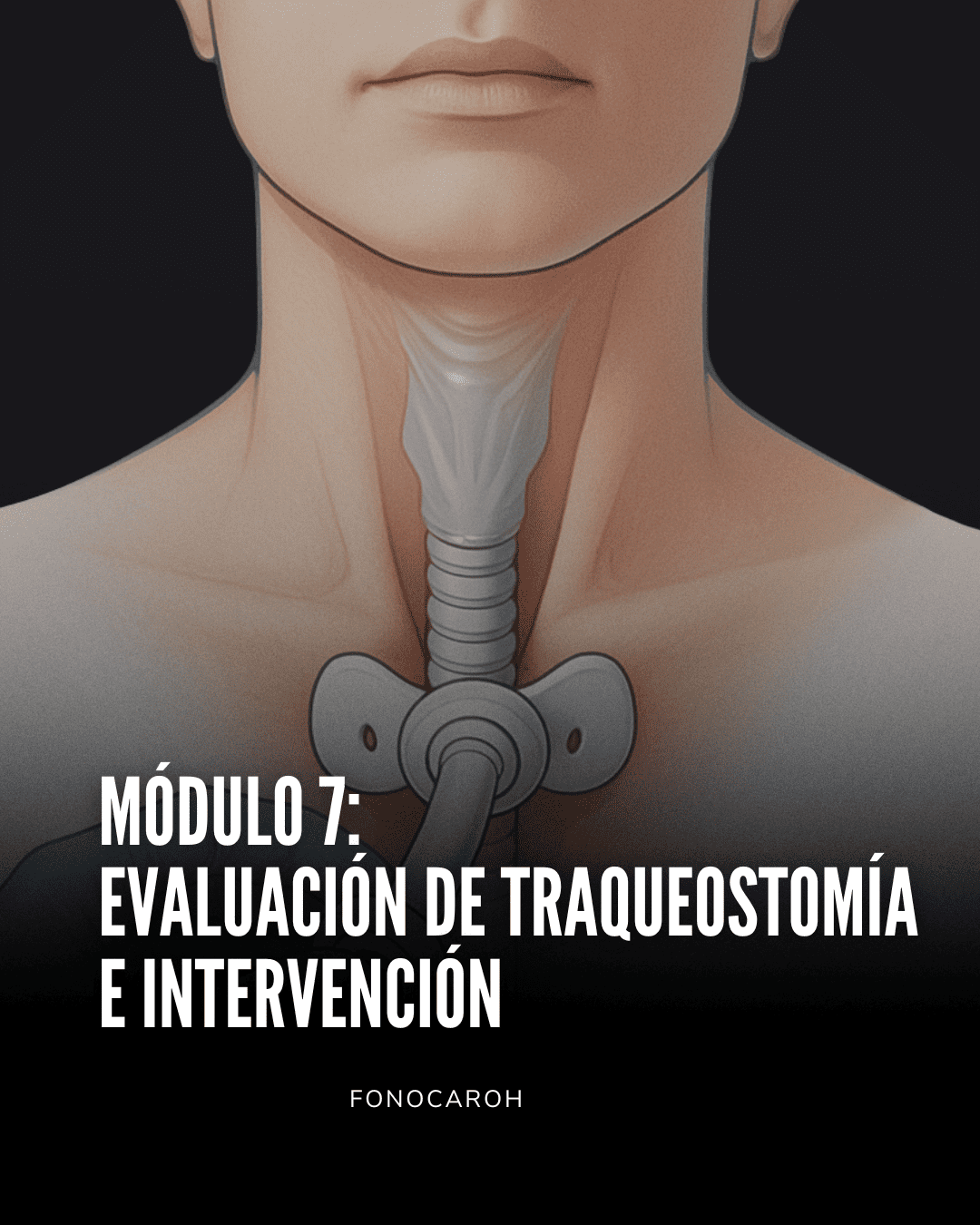 Módulo 7: Evaluación de Traqueostomía e Intervención - Curso Avanzado ELA